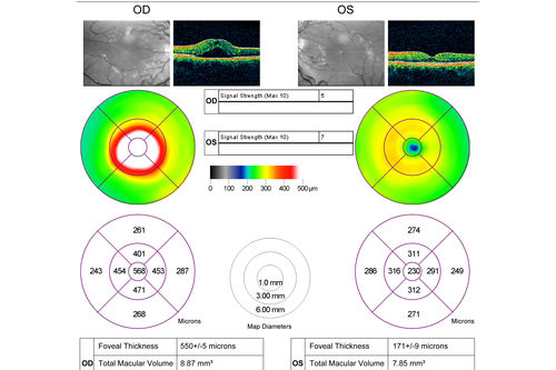 Acute Central Serous Retinopathy - Classic Smokestack on Fluorescein Angiogram 
34-year-old man noticed about five days ago decreased vision in the right eye.  He was having difficulty playing video games and seeing with that eye.  He thought maybe his refractive error was shifting.  
VISUAL ACUITY:  Vision OD is 20/40, OS is 20/16
