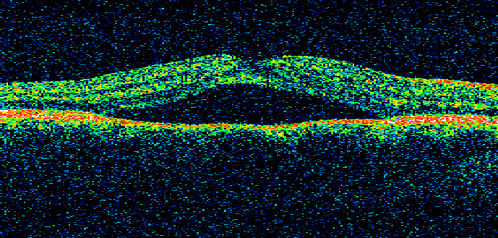 Acute Central Serous Retinopathy - Classic Smokestack on Fluorescein Angiogram 
34-year-old man noticed about five days ago decreased vision in the right eye.  He was having difficulty playing video games and seeing with that eye.  He thought maybe his refractive error was shifting.  
VISUAL ACUITY:  Vision OD is 20/40, OS is 20/16
