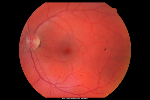 Central Serous Retinopathy - Steroid Induced - Serous Retinal Detachment
38-year-old man has noticed a spot in the right eye.  The vision was a little bit off for a few weeks and then just recently he noticed that it was the right eye.  He did take high dose oral steroids for about two weeks in early March and he was using an intermittent steroid inhaler, but he has not used anything recently.  He is under a lot of stress.  

VISUAL ACUITY:  OD 20/100,  OS 20/50.
