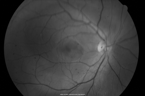Central Serous Retinopathy - Steroid Induced - Serous Retinal Detachment
38-year-old man has noticed a spot in the right eye.  The vision was a little bit off for a few weeks and then just recently he noticed that it was the right eye.  He did take high dose oral steroids for about two weeks in early March and he was using an intermittent steroid inhaler, but he has not used anything recently.  He is under a lot of stress.  

VISUAL ACUITY:  OD 20/100,  OS 20/50.
