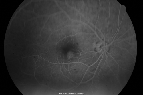 Central Serous Retinopathy - Steroid Induced - Serous Retinal Detachment
38-year-old man has noticed a spot in the right eye.  The vision was a little bit off for a few weeks and then just recently he noticed that it was the right eye.  He did take high dose oral steroids for about two weeks in early March and he was using an intermittent steroid inhaler, but he has not used anything recently.  He is under a lot of stress.  

VISUAL ACUITY:  OD 20/100,  OS 20/50.
