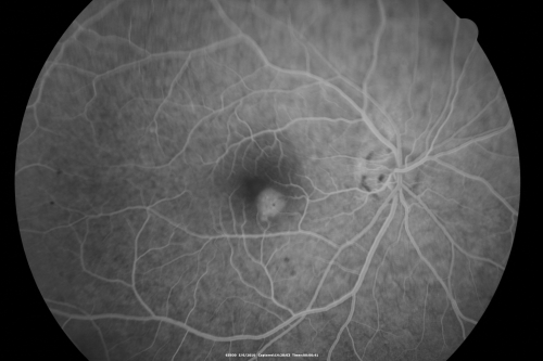 Central Serous Retinopathy - Steroid Induced - Serous Retinal Detachment
38-year-old man has noticed a spot in the right eye.  The vision was a little bit off for a few weeks and then just recently he noticed that it was the right eye.  He did take high dose oral steroids for about two weeks in early March and he was using an intermittent steroid inhaler, but he has not used anything recently.  He is under a lot of stress.  

VISUAL ACUITY:  OD 20/100,  OS 20/50.
