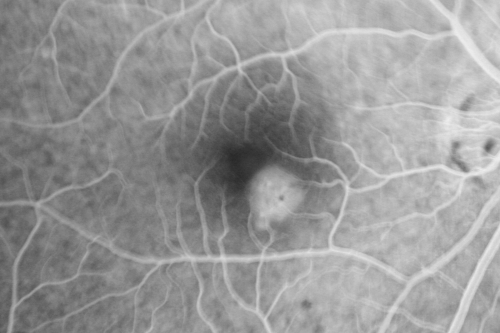 Central Serous Retinopathy - Steroid Induced - Serous Retinal Detachment
38-year-old man has noticed a spot in the right eye.  The vision was a little bit off for a few weeks and then just recently he noticed that it was the right eye.  He did take high dose oral steroids for about two weeks in early March and he was using an intermittent steroid inhaler, but he has not used anything recently.  He is under a lot of stress.  

VISUAL ACUITY:  OD 20/100,  OS 20/50.

