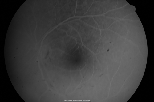 Central Serous Retinopathy - Steroid Induced - Serous Retinal Detachment
38-year-old man has noticed a spot in the right eye.  The vision was a little bit off for a few weeks and then just recently he noticed that it was the right eye.  He did take high dose oral steroids for about two weeks in early March and he was using an intermittent steroid inhaler, but he has not used anything recently.  He is under a lot of stress.  

VISUAL ACUITY:  OD 20/100,  OS 20/50.
