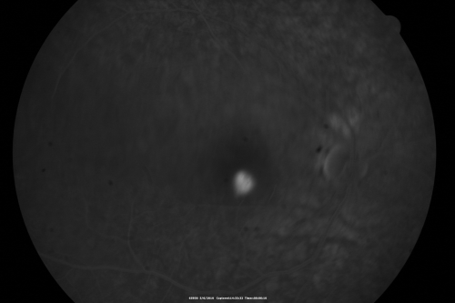 Central Serous Retinopathy - Steroid Induced - Serous Retinal Detachment
38-year-old man has noticed a spot in the right eye.  The vision was a little bit off for a few weeks and then just recently he noticed that it was the right eye.  He did take high dose oral steroids for about two weeks in early March and he was using an intermittent steroid inhaler, but he has not used anything recently.  He is under a lot of stress.  

VISUAL ACUITY:  OD 20/100,  OS 20/50.
