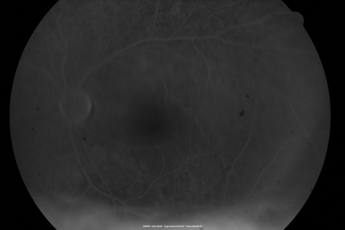 Central Serous Retinopathy - Steroid Induced - Serous Retinal Detachment
38-year-old man has noticed a spot in the right eye.  The vision was a little bit off for a few weeks and then just recently he noticed that it was the right eye.  He did take high dose oral steroids for about two weeks in early March and he was using an intermittent steroid inhaler, but he has not used anything recently.  He is under a lot of stress.  

VISUAL ACUITY:  OD 20/100,  OS 20/50.
