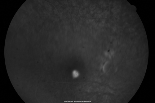 Central Serous Retinopathy - Steroid Induced - Serous Retinal Detachment
38-year-old man has noticed a spot in the right eye.  The vision was a little bit off for a few weeks and then just recently he noticed that it was the right eye.  He did take high dose oral steroids for about two weeks in early March and he was using an intermittent steroid inhaler, but he has not used anything recently.  He is under a lot of stress.  

VISUAL ACUITY:  OD 20/100,  OS 20/50.
