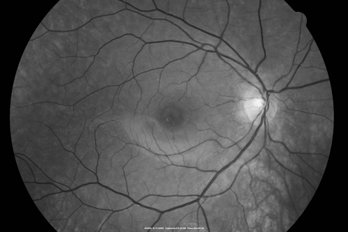 Cuticular Drusen - 26 year old female - Glomerulonephritis
VA 20/25 OU.  Images are over 4 years
