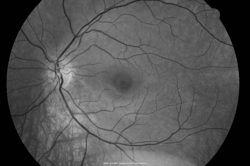 Cuticular Drusen - 26 year old female - Glomerulonephritis
VA 20/25 OU.  Images are over 4 years
