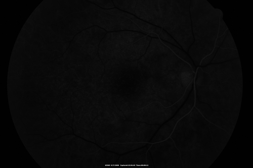 Cuticular Drusen - 26 year old female - Glomerulonephritis
VA 20/25 OU.  Images are over 4 years

