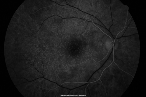 Cuticular Drusen - 26 year old female - Glomerulonephritis
VA 20/25 OU.  Images are over 4 years

