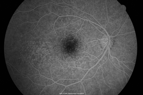 Cuticular Drusen - 26 year old female - Glomerulonephritis
VA 20/25 OU.  Images are over 4 years  FA shows starry sky early images - This is because of loss of RPE over the drusen creating very small window defects.
