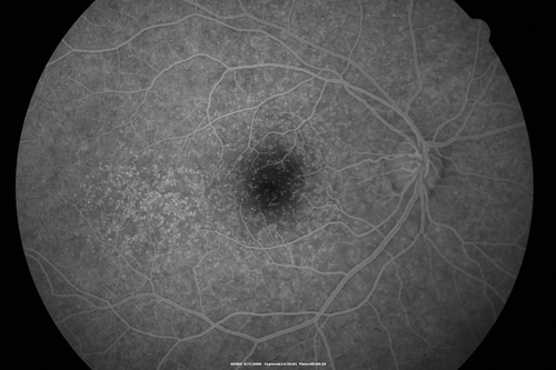 Cuticular Drusen - 26 year old female - Glomerulonephritis
VA 20/25 OU.  Images are over 4 years  FA shows starry sky early images - This is because of loss of RPE over the drusen creating very small window defects.
