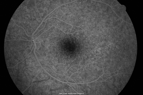 Cuticular Drusen - 26 year old female - Glomerulonephritis
VA 20/25 OU.  Images are over 4 years.  FA shows starry sky early images - This is because of loss of RPE over the drusen creating very small window defects.

