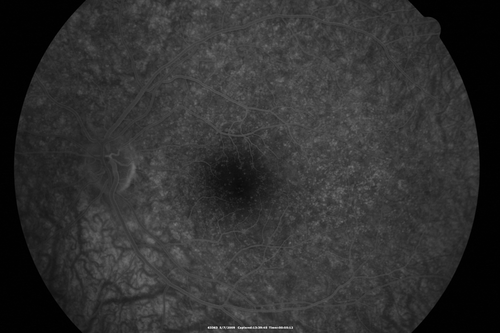 Cuticular Drusen - 26 year old female - Glomerulonephritis
VA 20/25 OU.  Images are over 4 years - FA shows starry sky early images - This is because of loss of RPE over the drusen creating very small window defects.
