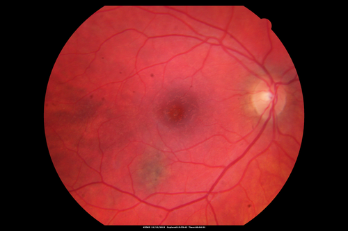 Cuticular Drusen - 26 year old female - Glomerulonephritis
VA 20/25 OU.  Images are over 4 years
