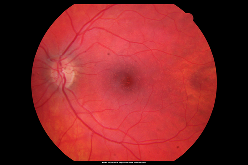 Cuticular Drusen - 26 year old female - Glomerulonephritis
VA 20/25 OU.  Images are over 4 years
