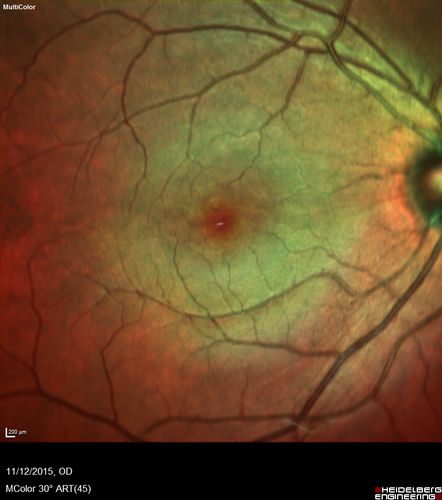 Cuticular Drusen - 26 year old female - Glomerulonephritis
VA 20/25 OU.  Images are over 4 years
