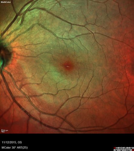 Cuticular Drusen - 26 year old female - Glomerulonephritis
VA 20/25 OU.  Images are over 4 years
