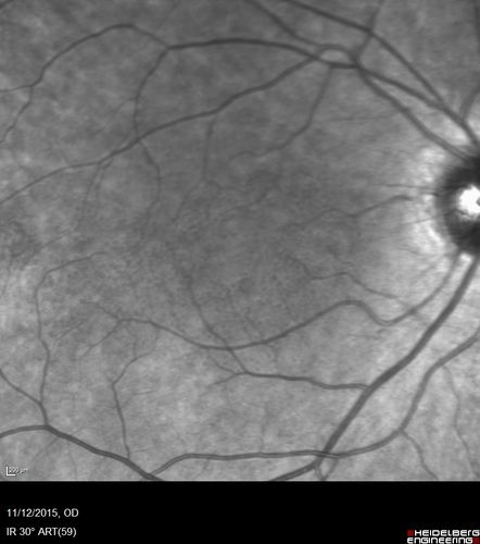 Cuticular Drusen - 26 year old female - Glomerulonephritis
VA 20/25 OU.  Images are over 4 years
