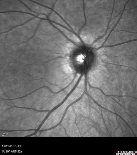 Cuticular Drusen - 26 year old female - Glomerulonephritis
VA 20/25 OU.  Images are over 4 years
