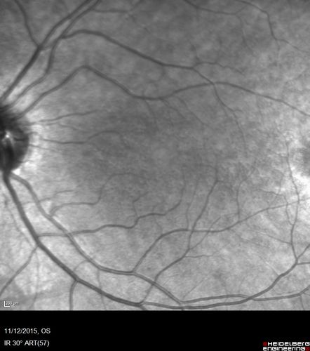 Cuticular Drusen - 26 year old female - Glomerulonephritis
VA 20/25 OU.  Images are over 4 years
