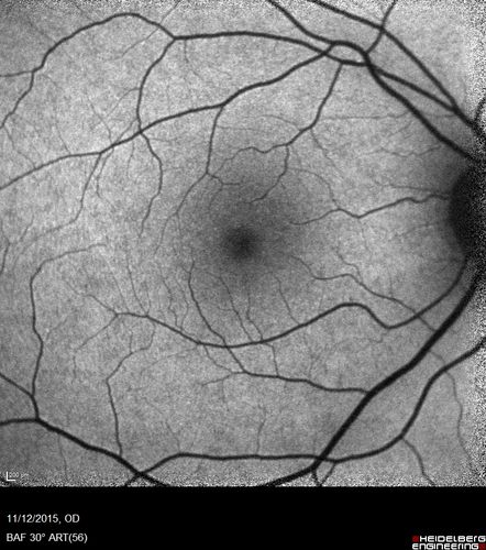 Cuticular Drusen - 26 year old female - Glomerulonephritis
VA 20/25 OU.  Images are over 4 years
