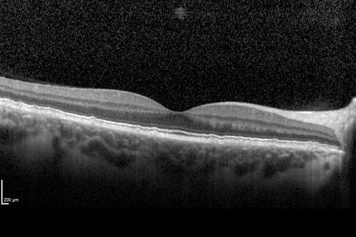 Cuticular Drusen - 26 year old female - Glomerulonephritis
VA 20/25 OU.  Images are over 4 years
