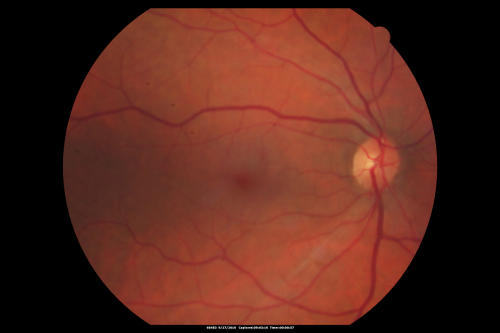 Cotton Wool Spots now Gone in Both Eyes
60-year-old man was sick in the hospital in 3 month ago with streptococcal pneumonia.  He was in the cardiac intensive care unit and at one point he was in critical condition. He has no visual complaints. OD 20/20,  OS 20/25.  Cotton Wool Spots now GONE
