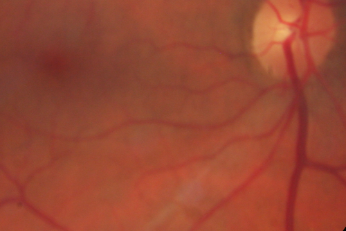 Cotton Wool Spots now Gone in Both Eyes
60-year-old man was sick in the hospital in 3 month ago with streptococcal pneumonia.  He was in the cardiac intensive care unit and at one point he was in critical condition. He has no visual complaints. OD 20/20,  OS 20/25.  Cotton Wool Spots now GONE
