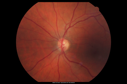 Cotton Wool Spots now Gone in Both Eyes
60-year-old man was sick in the hospital in 3 month ago with streptococcal pneumonia.  He was in the cardiac intensive care unit and at one point he was in critical condition. He has no visual complaints. OD 20/20,  OS 20/25.  Cotton Wool Spots now GONE
