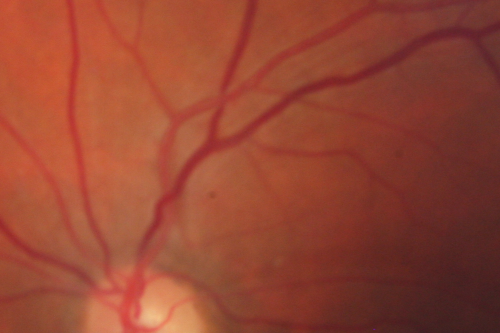 Cotton Wool Spots now Gone in Both Eyes
60-year-old man was sick in the hospital in 3 month ago with streptococcal pneumonia.  He was in the cardiac intensive care unit and at one point he was in critical condition. He has no visual complaints. OD 20/20,  OS 20/25.  Cotton Wool Spots now GONE
