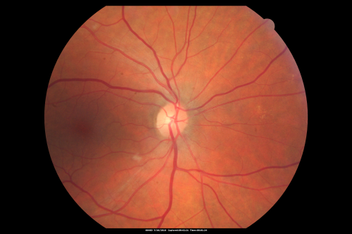 Cotton Wool Spots Both Eyes after Strep Pneumonia and Cardiac ICU Stay 1 Month Ago 
60-year-old man was sick in the hospital in 1 month ago with streptococcal pneumonia.  He was in the cardiac intensive care unit and at one point he was in critical condition. He has no visual complaints. OD 20/20,  OS 20/25.
