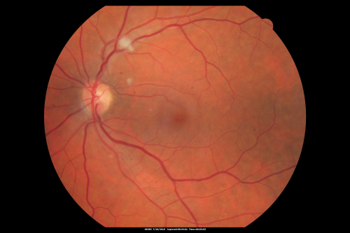 Cotton Wool Spots Both Eyes after Strep Pneumonia and Cardiac ICU Stay 1 Month Ago 
60-year-old man was sick in the hospital in 1 month ago with streptococcal pneumonia.  He was in the cardiac intensive care unit and at one point he was in critical condition. He has no visual complaints. OD 20/20,  OS 20/25.
