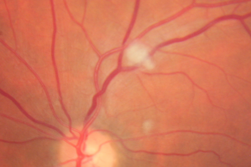 Cotton Wool Spots Both Eyes after Strep Pneumonia and Cardiac ICU Stay 1 Month Ago 
60-year-old man was sick in the hospital in 1 month ago with streptococcal pneumonia.  He was in the cardiac intensive care unit and at one point he was in critical condition. He has no visual complaints. OD 20/20,  OS 20/25.
