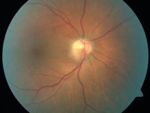 Non-Arteritic Anterior Ischemic Optic Neuropathy - Peripapillary Choroidal Ischemia
68-year-old woman noticed central vision loss in the right eye about a week ago.  It is getting a little bit better.   OD 20/160, OS 20/25.
