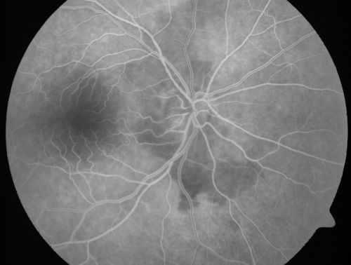 Non-Arteritic Anterior Ischemic Optic Neuropathy - Peripapillary Choroidal Ischemia
68-year-old woman noticed central vision loss in the right eye about a week ago.  It is getting a little bit better.   OD 20/160, OS 20/25.
