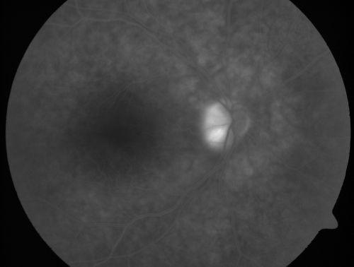 Non-Arteritic Anterior Ischemic Optic Neuropathy - Peripapillary Choroidal Ischemia
68-year-old woman noticed central vision loss in the right eye about a week ago.  It is getting a little bit better.   OD 20/160, OS 20/25.
