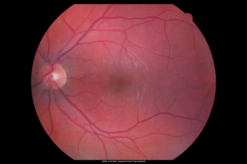 Steel Dart Perforating Injury - 15 year old - 3 weeks post-injury Vision 20/400
16-year-old had a dart injury to the left eye August 3rd of 2009.  He has had a few surgeries since then, although he never did require a vitrectomy.  His vision is improving remarkably.  

VISUAL ACUITY:  OS: Without correction 20/40
Keywords: vitreous hemorrhage; choroidal rupture