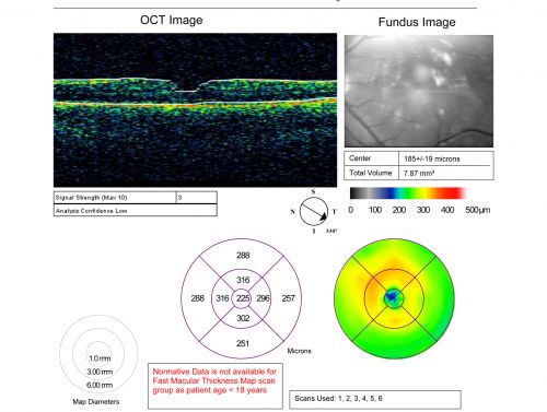 Perforating Steel Tip Dart Injury - 1 year later - no vitrectomy - 20/40 Vision 
16-year-old had a dart injury to the left eye one year ago.  His vision is improving remarkably.  

VISUAL ACUITY:  OS: 20/40
Keywords: vitreous hemorrhage; choroidal rupture