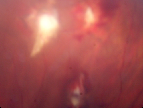 Steel Dart Perforating Injury - 15 year old - 3 weeks post-injury Vision 20/400
15-year-old injured in his left eye with a steel dart.    The dart entered superiorly at the pars plana and his vision is clearing as the blood absorbs.  

VISUAL ACUITY:  OD 20/20,  OS 20/400.
Keywords: vitreous hemorrhage; choroidal rupture