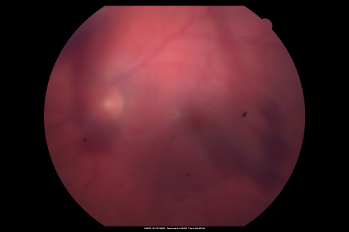 Steel Dart Perforating Injury - 15 year old - 3 weeks post-injury Vision 20/400
15-year-old injured in his left eye with a steel dart.    The dart entered superiorly at the pars plana and his vision is clearing as the blood absorbs.  

VISUAL ACUITY:  OD 20/20,  OS 20/400.
Keywords: vitreous hemorrhage; choroidal rupture