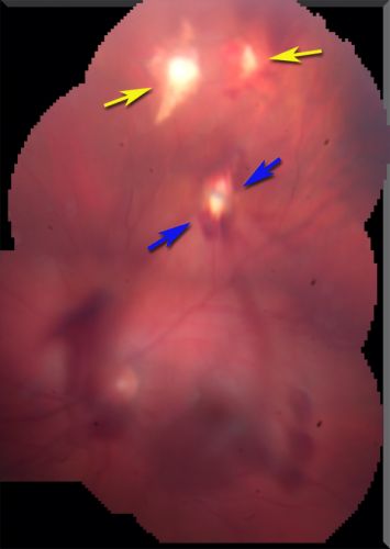 Steel Dart Perforating Injury - 15 year old - 3 weeks post-injury Vision 20/400
15-year-old injured in his left eye with a steel dart.    The dart entered superiorly at the pars plana and his vision is clearing as the blood absorbs.  

VISUAL ACUITY:  OD 20/20,  OS 20/400.
Keywords: vitreous hemorrhage; choroidal rupture