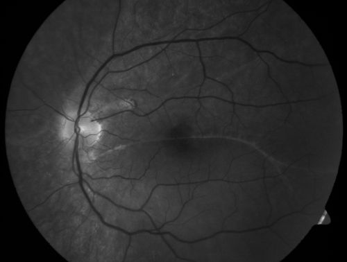 Macular Demarcation line and Symptomatic Distortion 3 years following Asymptomatic Retinal Detachment Repair
 41-year-old man had an asymptomatic retinal detachment repair in the left eye on New Years Eve in December of 2007 in Wake Forest, North Carolina (3 years ago).  Since then he has had problems with distortion and pinching.  When he looks at long words, the very center letters are abnormal.
 OD is 20/20, OS is 20/80
