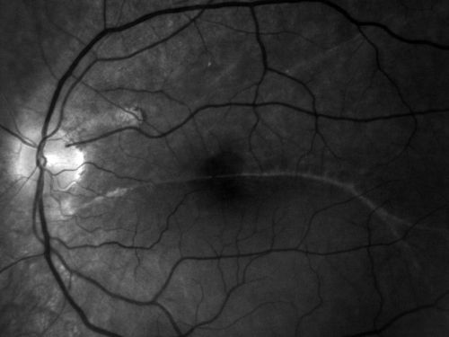 Macular Demarcation line and Symptomatic Distortion 3 years following Asymptomatic Retinal Detachment Repair
 41-year-old man had an asymptomatic retinal detachment repair in the left eye on New Years Eve in December of 2007 in Wake Forest, North Carolina (3 years ago).  Since then he has had problems with distortion and pinching.  When he looks at long words, the very center letters are abnormal.
 OD is 20/20, OS is 20/80
