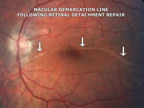 Macular Demarcation line and Symptomatic Distortion 3 years following Asymptomatic Retinal Detachment Repair
 41-year-old man had an asymptomatic retinal detachment repair in the left eye on New Years Eve in December of 2007 in Wake Forest, North Carolina (3 years ago).  Since then he has had problems with distortion and pinching.  When he looks at long words, the very center letters are abnormal.
 OD is 20/20, OS is 20/80
