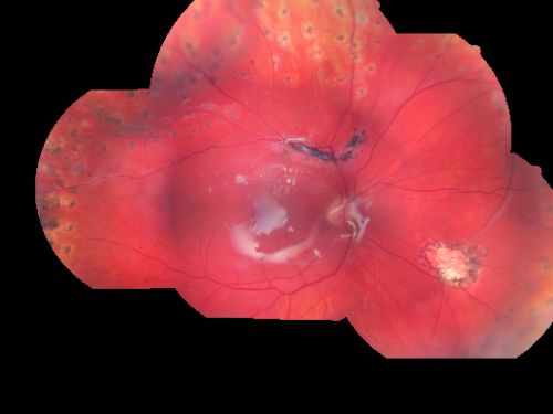 Giant Retinal Diaylsis Retinal Detachment - Post-op 2 months vision reasonable under silicone oil - Retina Attached
2 months post-op with silicone oil in eye.
