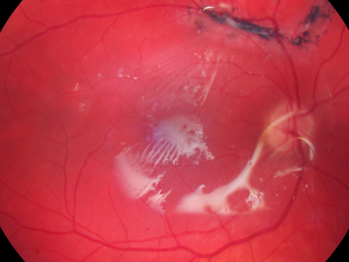 Giant Retinal Diaylsis Retinal Detachment - Post-op 2 months vision reasonable under silicone oil - Retina Attached
2 months post-op with silicone oil in eye.
