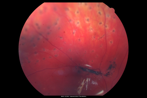 Giant Retinal Diaylsis Retinal Detachment - Post-op 2 months vision reasonable under silicone oil - Retina Attached
2 months post-op with silicone oil in eye.
