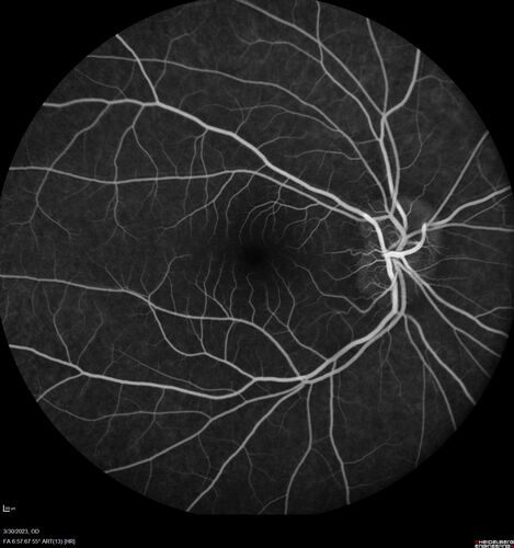 Disc drusen 8 year old boy - fluorescein shows no leakage
8 year old boy with headache and nausea.  He had a negative MRI. Images show hyper FAF from drusen and no leakage on FA.  No spinal tap was done.  VA was 20/40 both eyes.
